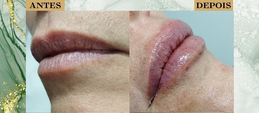 Preenchimento Facial São José dos Campos | Flor de Lis
