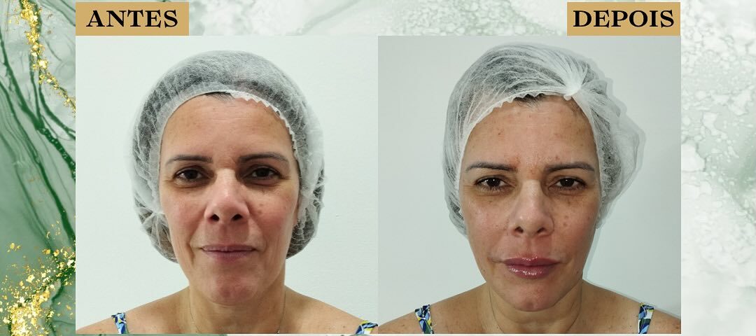 Botox São José dos Campos | Flor de Lis Botox São José dos Campos | Flor de Lis