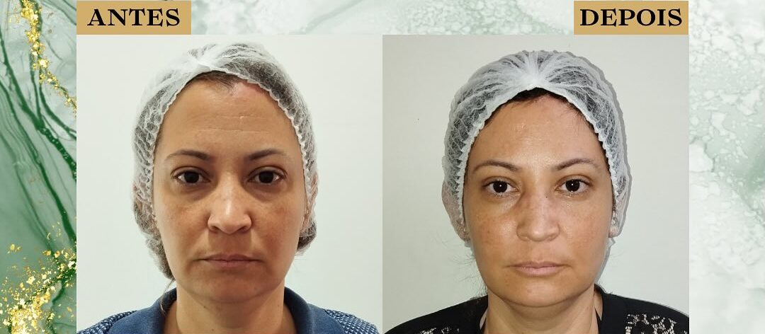 Botox São José dos Campos | Flor de Lis Botox São José dos Campos | Flor de Lis