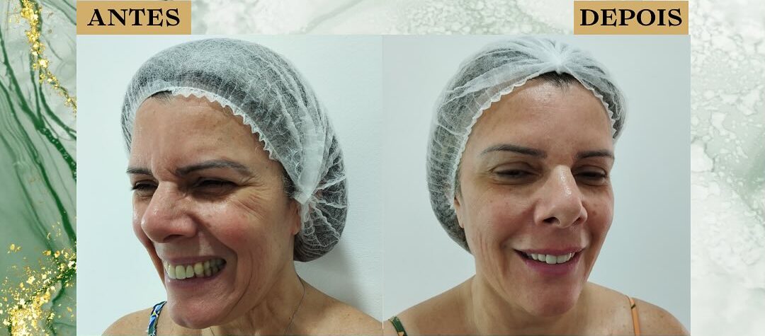 Botox São José dos Campos | Flor de Lis Botox São José dos Campos | Flor de Lis