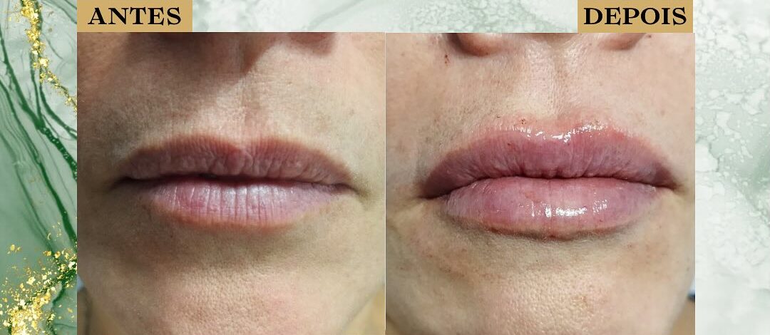 Preenchimento Facial São José dos Campos | Flor de Lis