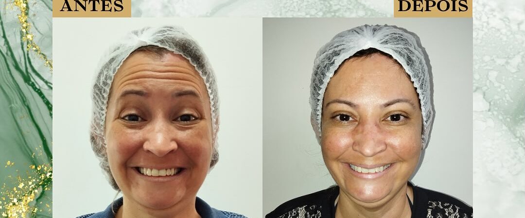 Botox São José dos Campos | Flor de Lis