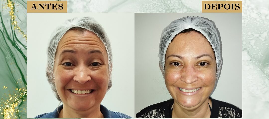 Botox São José dos Campos | Flor de Lis
