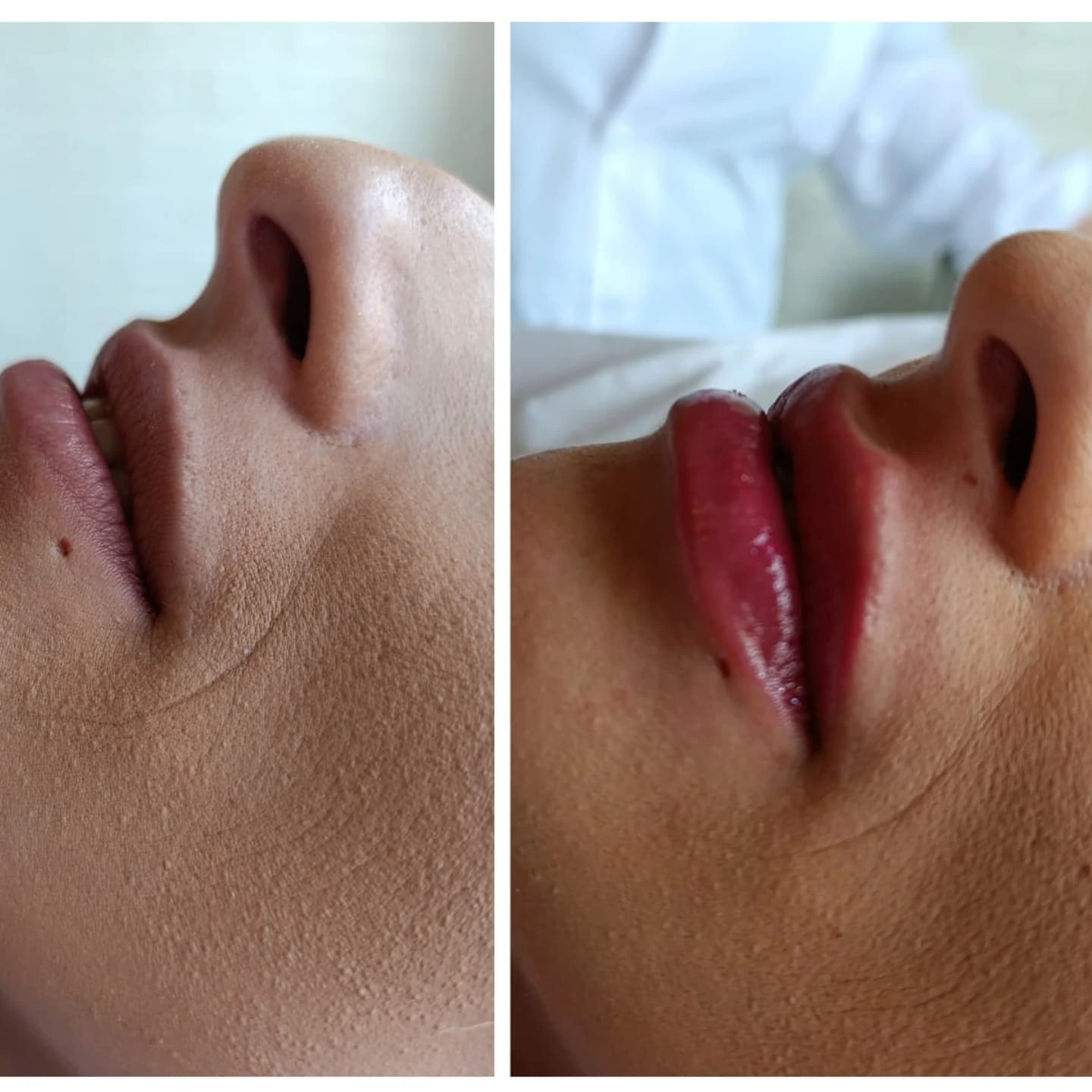 Resultado procedimento Flor de Lis