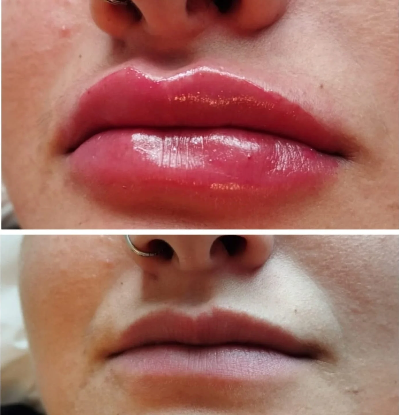 Preenchimento Facial São José dos Campos | Flor de Lis