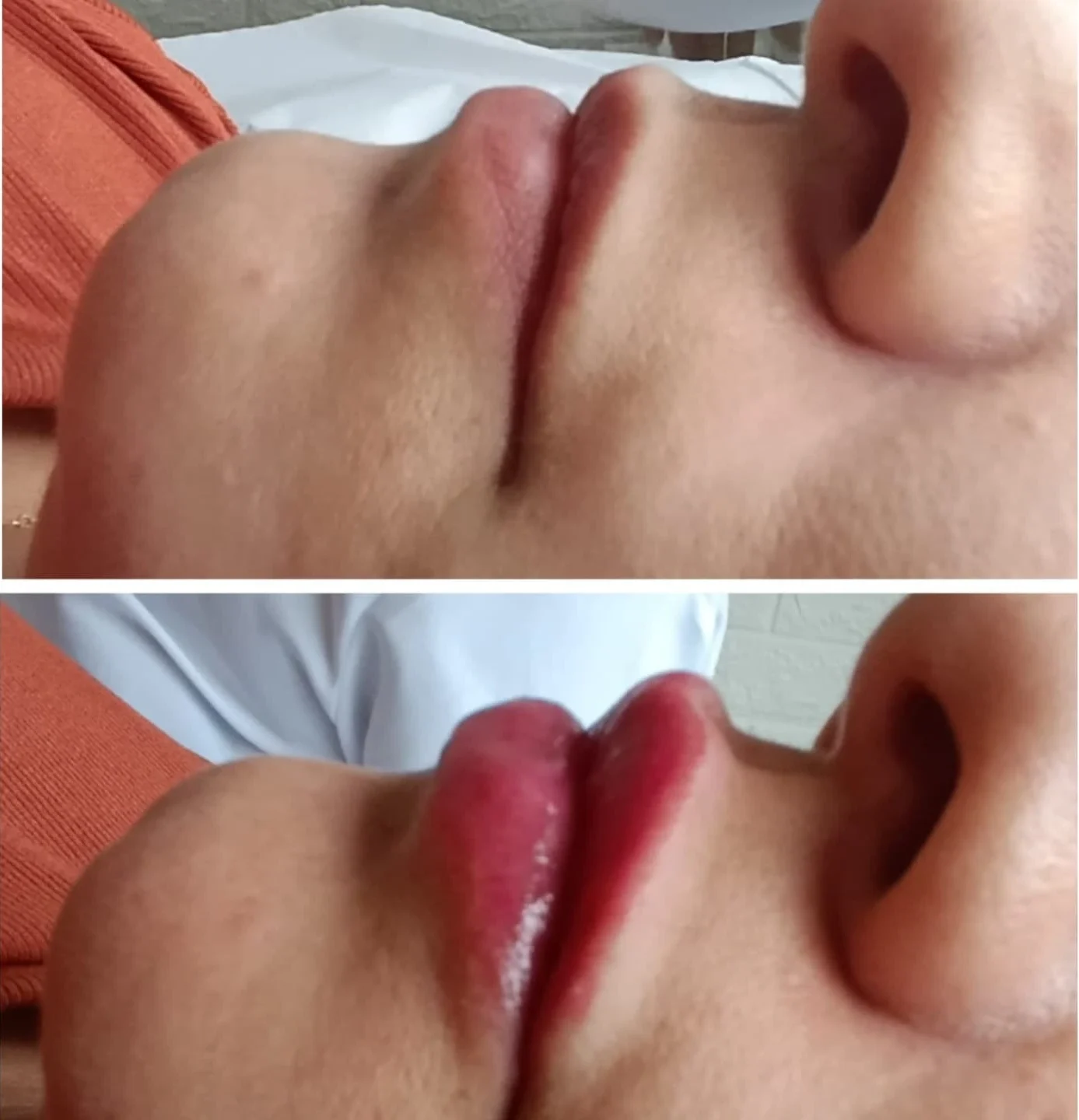 Preenchimento Facial São José dos Campos | Flor de Lis