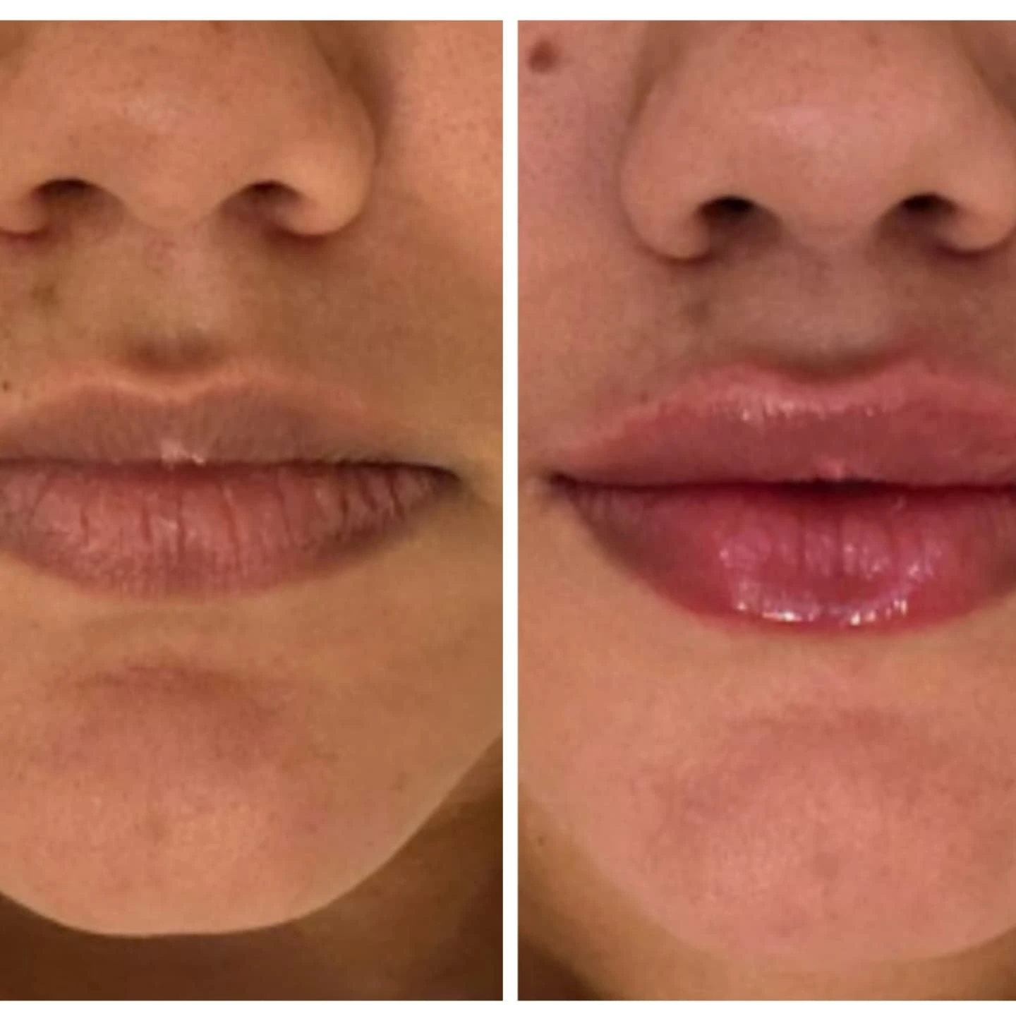 Preenchimento Facial São José dos Campos | Flor de Lis