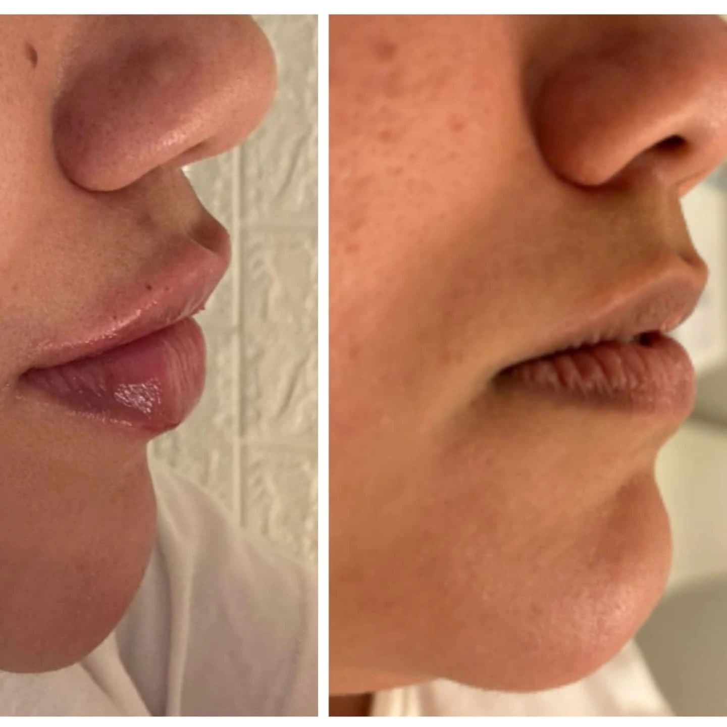 Resultado procedimento Flor de Lis