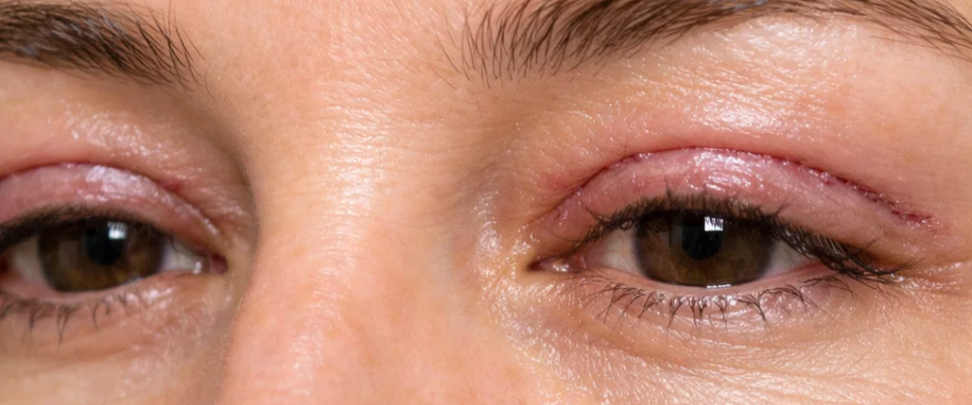 Blefaroplastia São José dos Campos | Flor de Lis