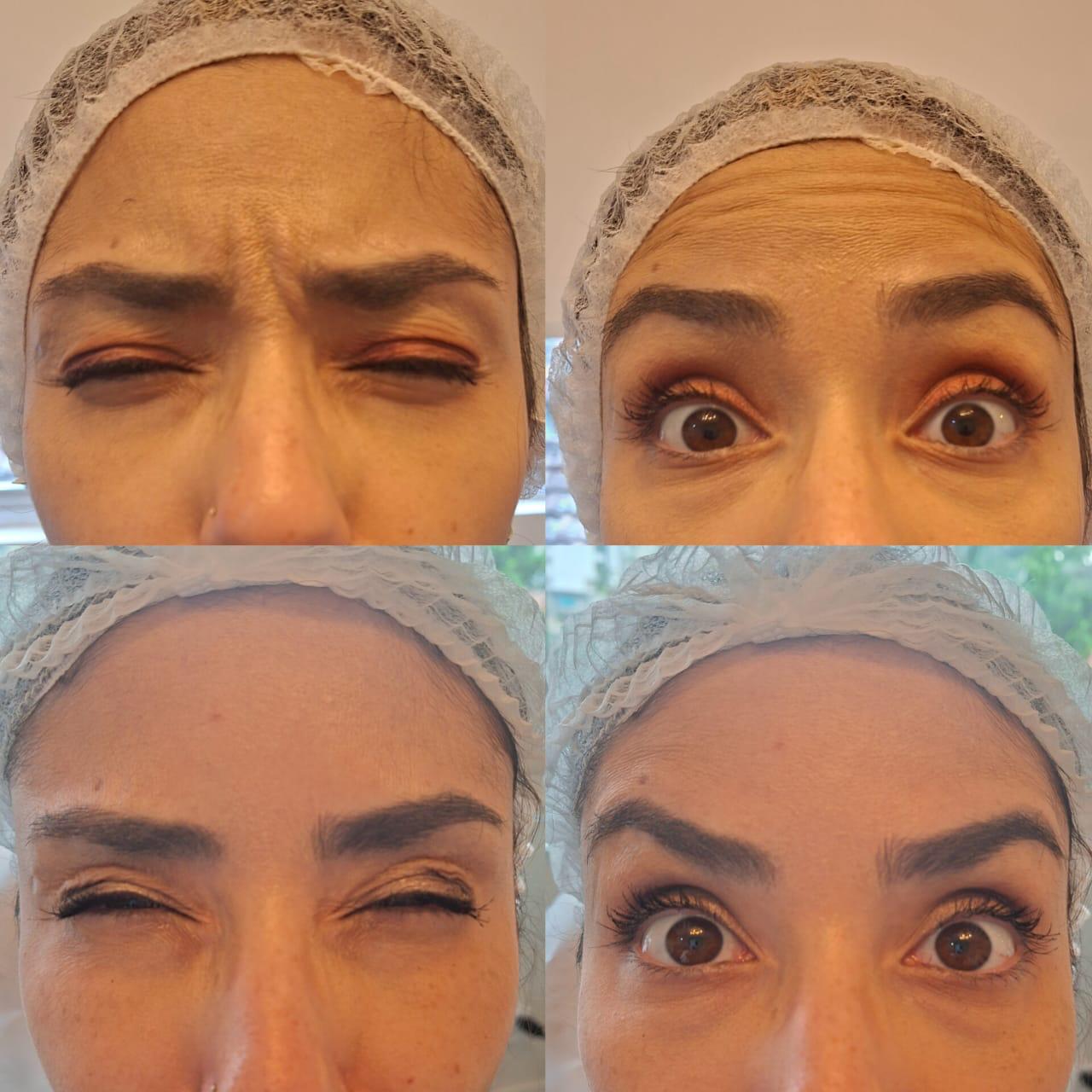 Resultado procedimento Flor de Lis