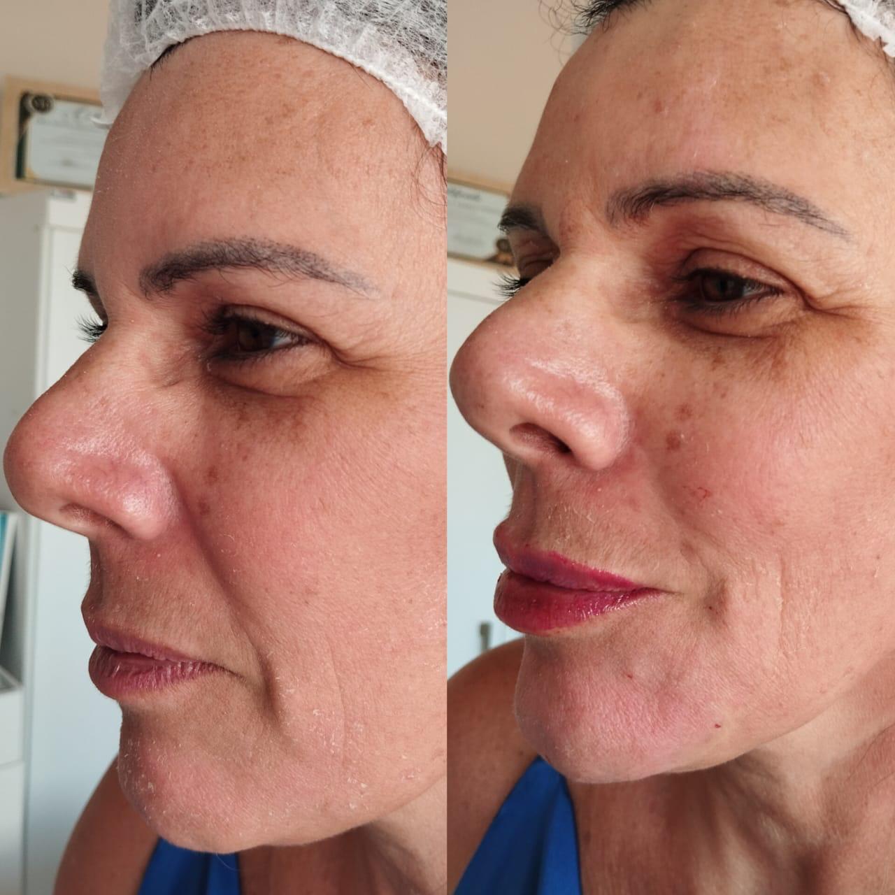 Resultado procedimento Flor de Lis