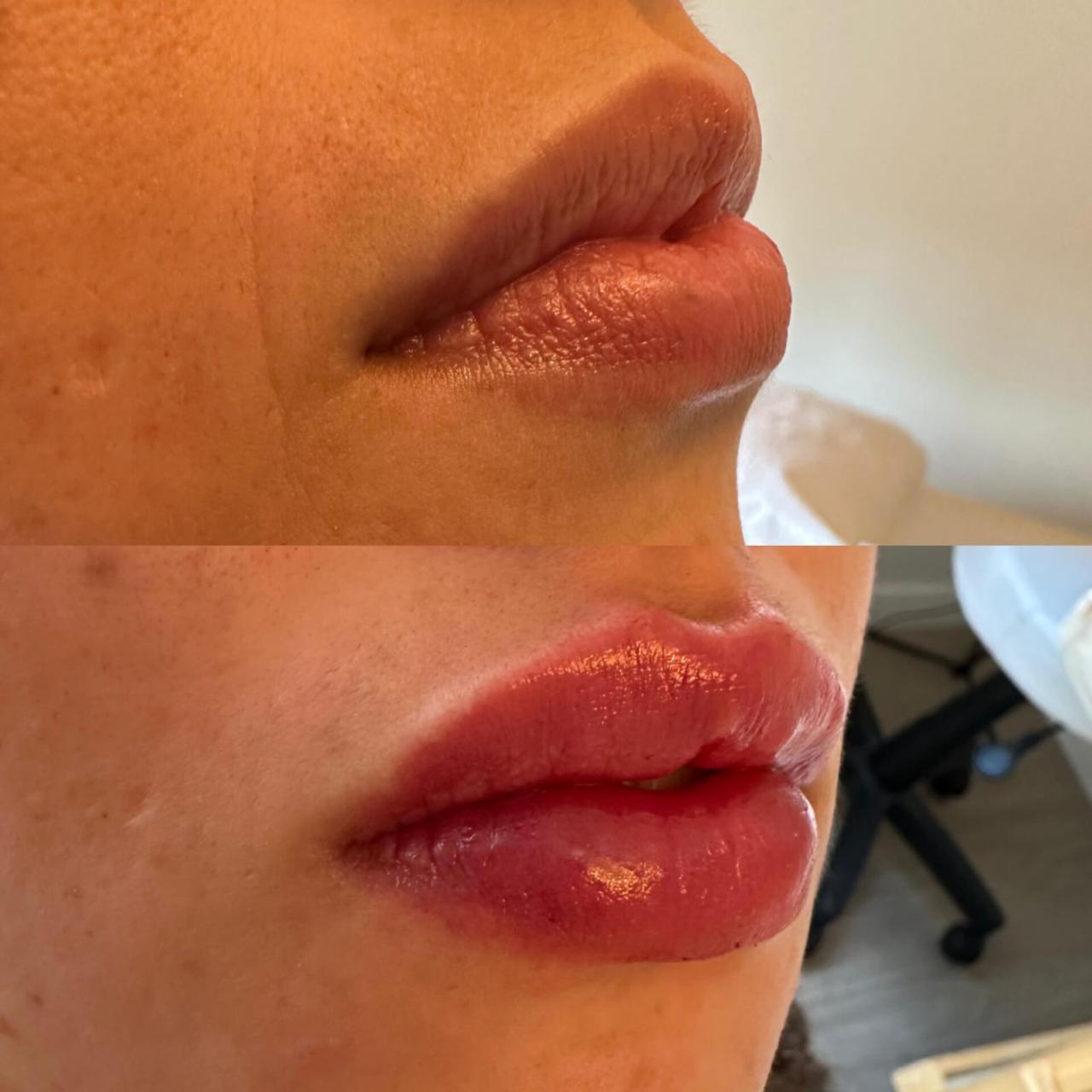 Preenchimento Facial São José dos Campos | Flor de Lis