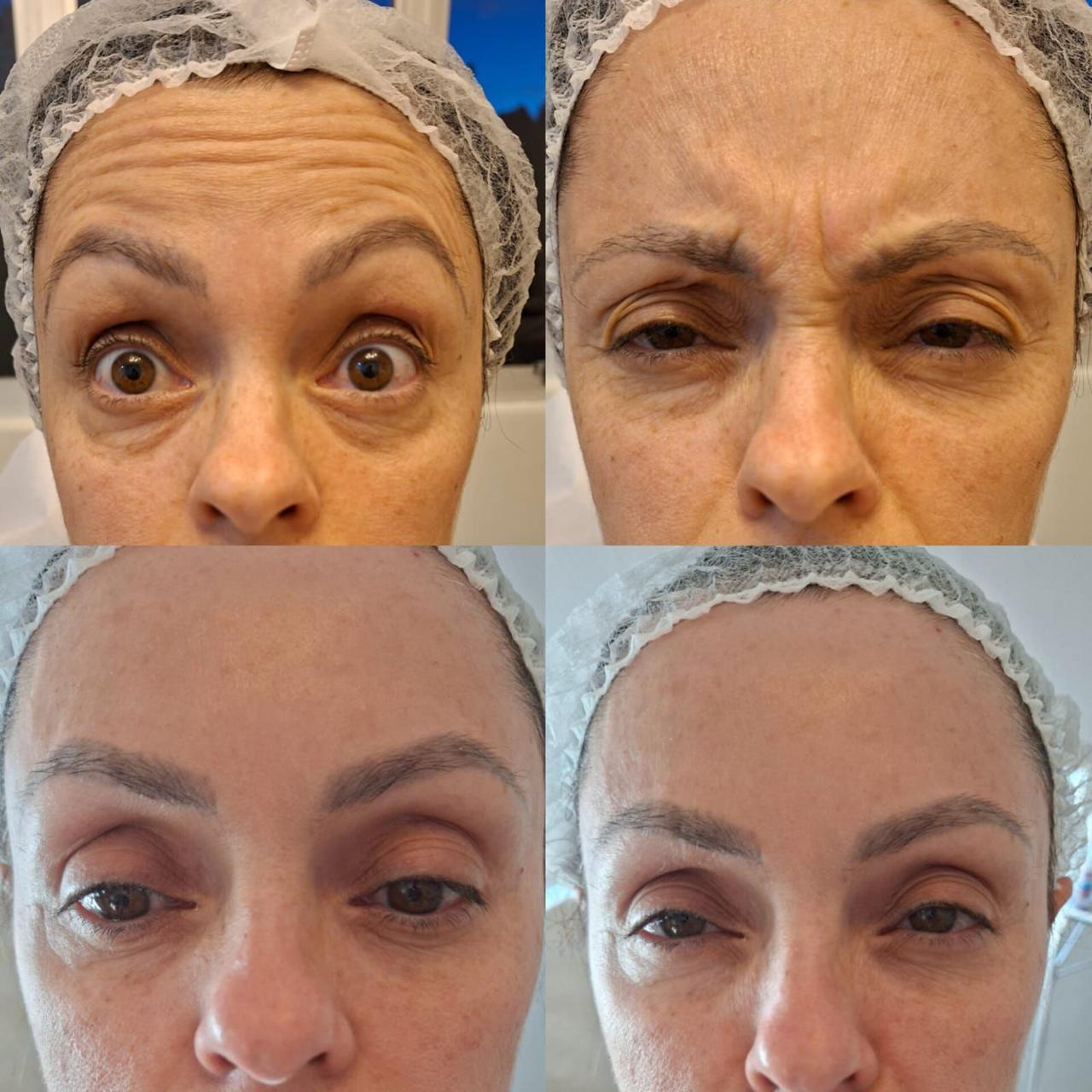 Resultado procedimento Flor de Lis